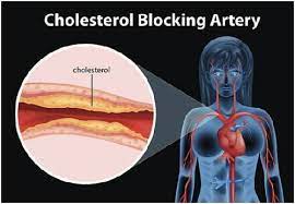 Cholesterol blocking Artery