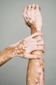 Vitiligo patches on hands.